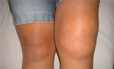 The causes of osteoarthritis of the knee joint