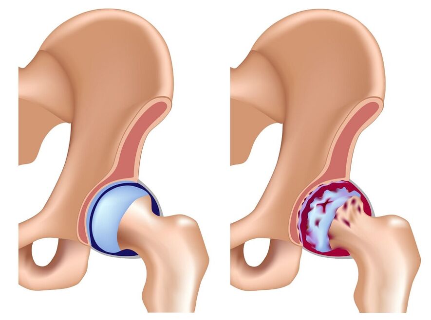 healthy joint and hip osteoarthritis