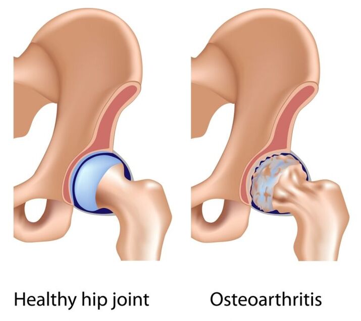 healthy joint and hip osteoarthritis